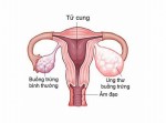 3 bệnh ung thư đường sinh dục ở phụ nữ