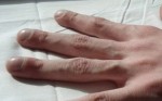 3 thay đổi ở ngón tay có thể báo hiệu nhiều bệnh ung thư