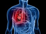 4 dấu hiệu ít ai để ý nhưng lại là dấu hiệu cảnh báo ung thư phổi đang đến gần