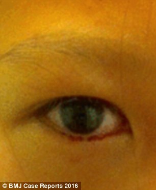 Khóc ra máu vì kính áp tròng kẹt trong mắt suốt 2 năm