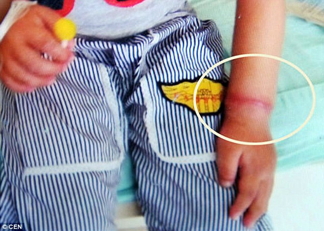 Cảnh báo: Cậu bé 4 tuổi suýt bị cắt tay vì một chiếc vòng chun