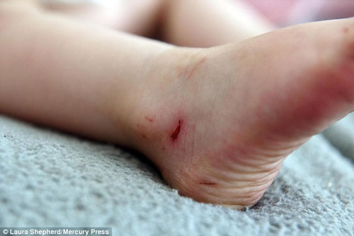 Giật mình chân bé gái 2 tuổi bỗng 'ứa máu' sau khi đi đôi dép xăng đan 30 phút