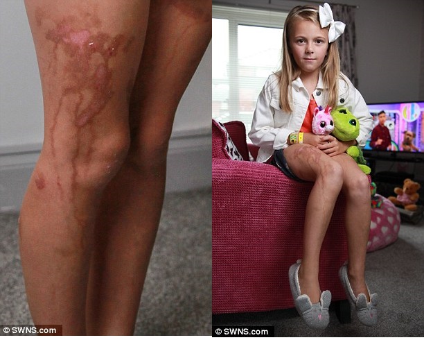 [Sử dụng kem chống nắng, cô bé 9 tuổi bị cháy da nghiêm trọng như bị nhỏ axit