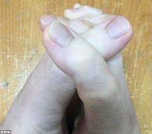 Kỳ lạ cô gái có bàn chân với những ngón dài giống bàn tay