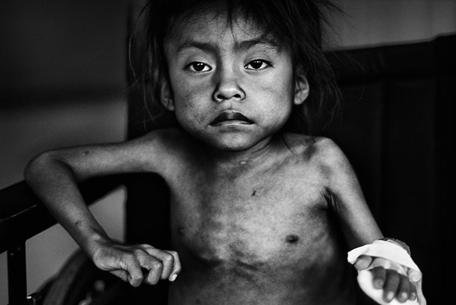 Những hình ảnh đáng sợ khi trẻ bị nhiễm độc chì
