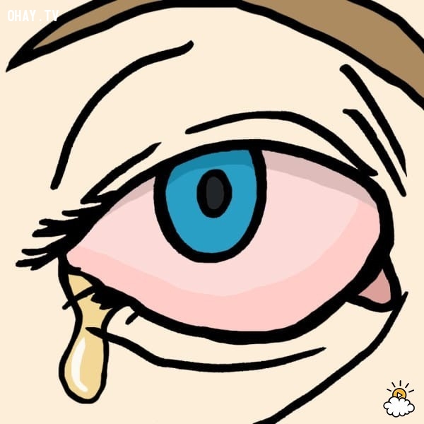 Cách chữa đau mắt đỏ tại nhà