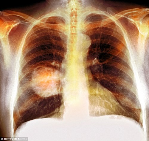 Hàng triệu người không biết họ đang mắc ung thư phổi
