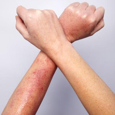 Loạt bệnh ngoài da thường gặp vào mùa hè và cách xử lý