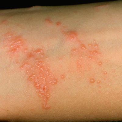 Loạt bệnh ngoài da thường gặp vào mùa hè và cách xử lý