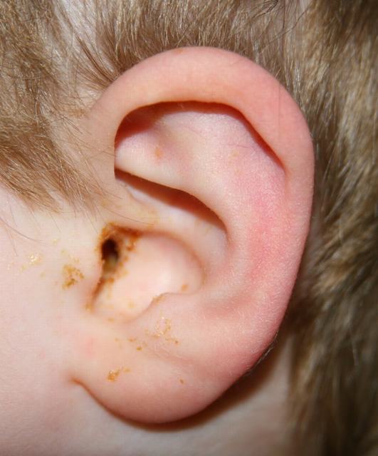 Muối + 1 chiếc tất: Trị hiệu quả viêm tai, nhiễm trùng tai cho trẻ