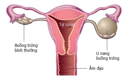 Tất tần tật thông tin về u nang buồng trứng mà chị em cần phải biết