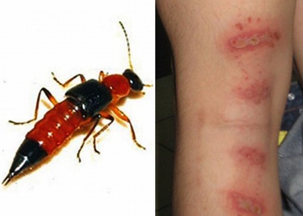Trúng độc kiến ba khoang gây biến chứng do xử lý sai cách