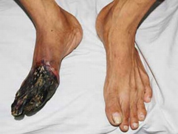 3 thói quen xấu khiến tay chân bị hủy hoại và biến dạng khủng khiếp