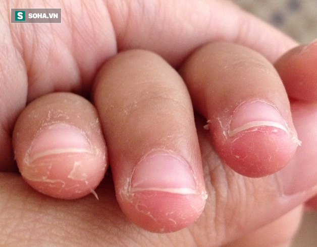 Bé 7 tuổi suýt bị cắt bỏ ngón tay vì thói quen 