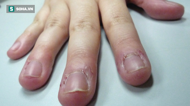 Bé 7 tuổi suýt bị cắt bỏ ngón tay vì thói quen 