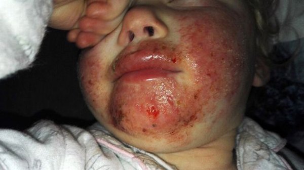 'Nụ hôn thần chết' khiến bé gái 2 tuổi bị lở loét, đau đớn suốt 8 tháng trời