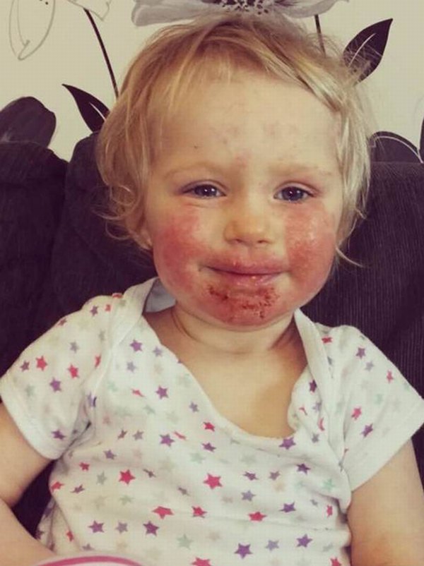 'Nụ hôn thần chết' khiến bé gái 2 tuổi bị lở loét, đau đớn suốt 8 tháng trời