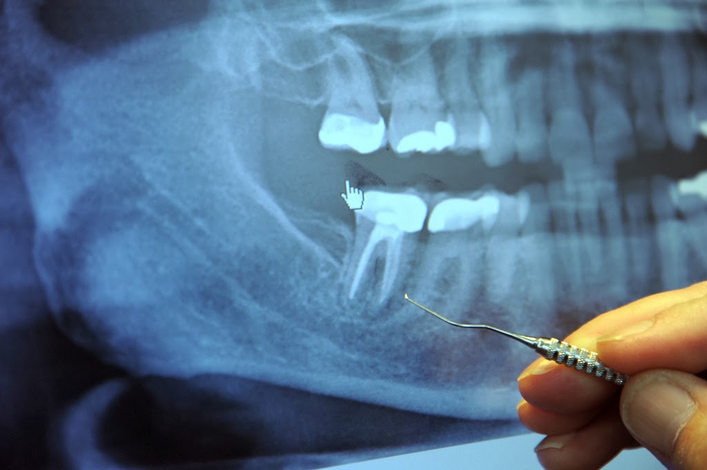 Thiếu răng có thể làm ảnh hưởng tới trí nhớ và sức khỏe cơ thể