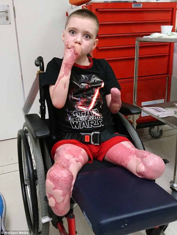 Bé trai bị ăn cụt cả chân lẫn tay sau khi ngủ dậy vì căn bệnh không ai ngờ tới