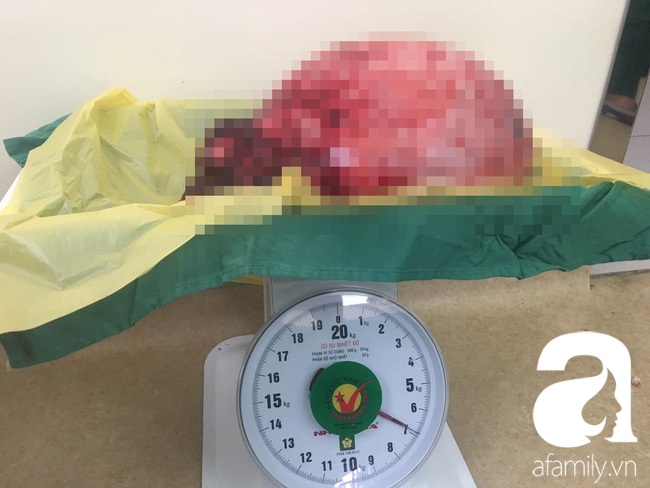 'Cứu sống một phụ nữ mang khối u trong tử cung nặng đến…12kg