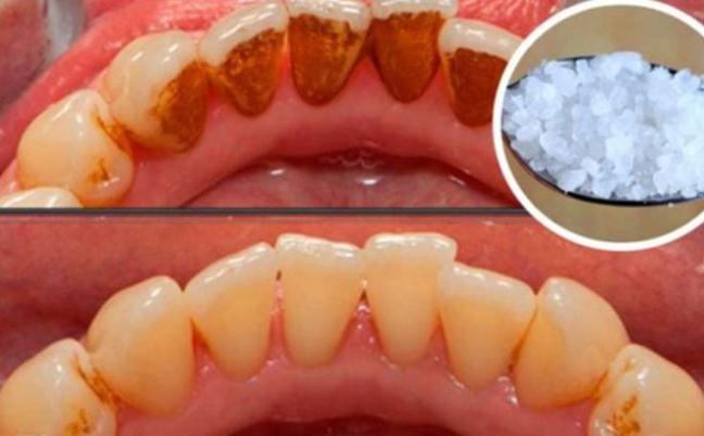 Không sử dụng thuốc hóa chất, cao răng vẫn sạch bóng nhờ cách đơn giản này