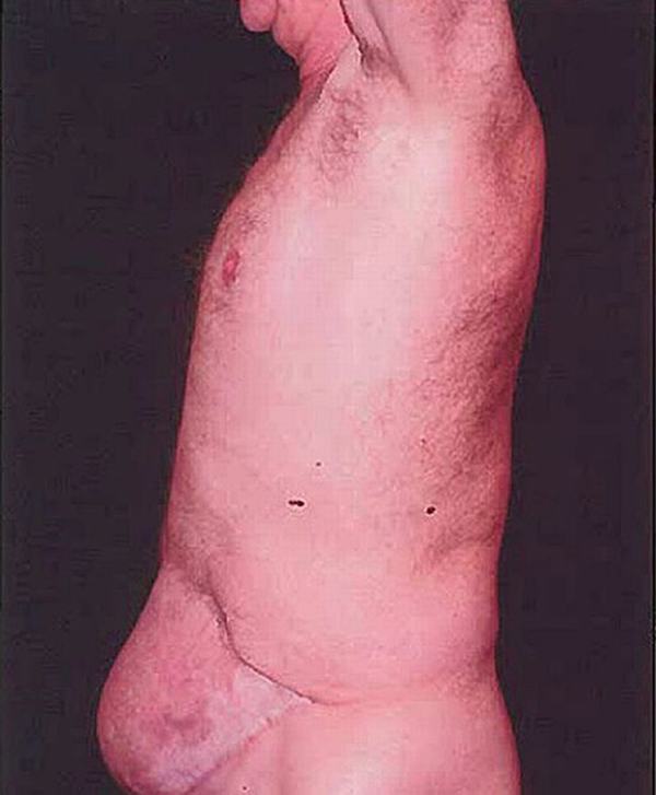 Trải qua ca phẫu thuật cắt tuyến tiền liệt, người đàn ông ở Anh đã mất hầu hết “của quý” vì bị nhiễm vi khuẩn ăn thịt.