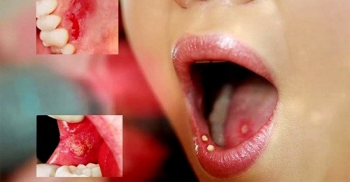 Hãy nhìn vết loét trên miệng để biết bạn có ung thư hay không