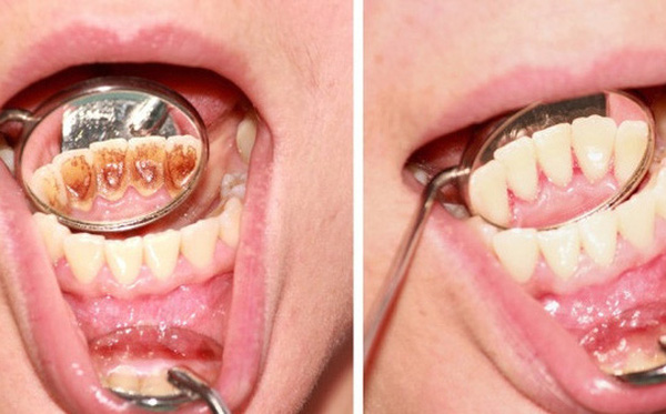 Khỏi đến nha sĩ, chỉ vài nghìn đồng và 5 phút là bạn có thể lấy sạch cao răng để đón Tết