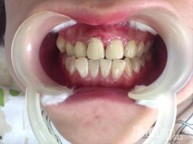 Làm răng sứ giá rẻ, cô gái choáng váng khi phải cắt 5 răng hàm trên