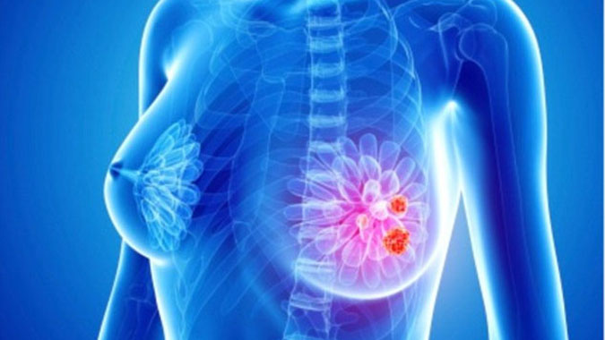 4 loại 'khí' nguy hiểm cho sức khỏe bản thân, có thể là nguyên nhân dẫn tới ung thư vú