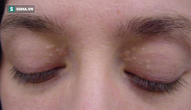 Mắt có một trong các dấu hiệu này, hãy cảnh giác nguy cơ mắc 9 loại bệnh nguy hiểm
