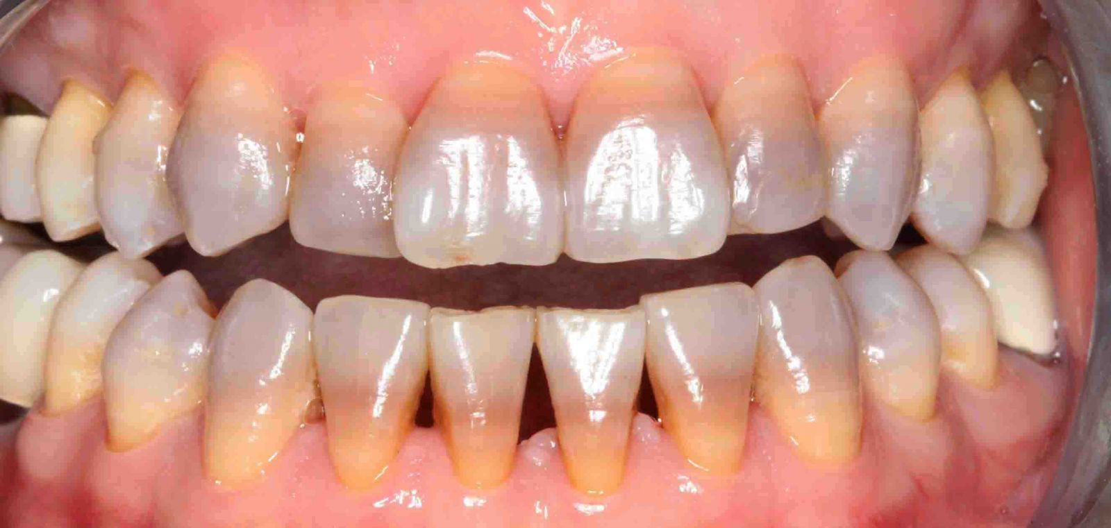 Rụng răng, tụt lợi vì thuốc tẩy trắng răng tại nhà
