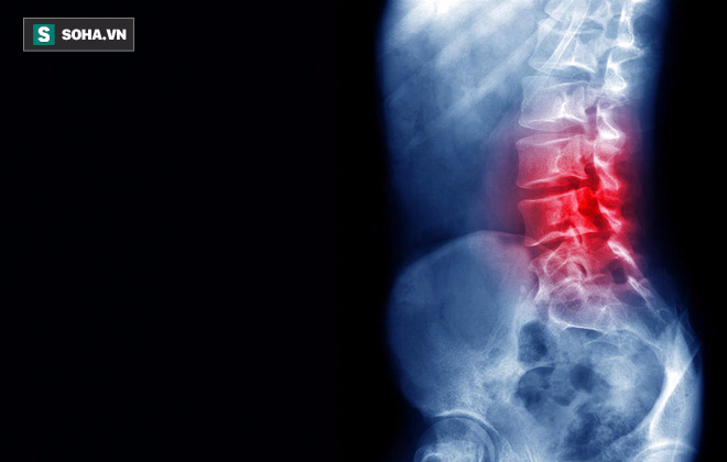 5 căn bệnh nguy hiểm đằng sau mỗi cơn đau lưng: Đừng chủ quan!
