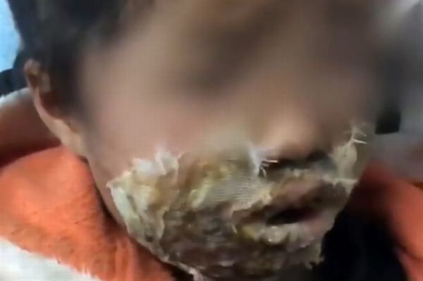 Bé gái 4 tuổi bị biến dạng vĩnh viễn gương mặt vì thói quen nguy hiểm này