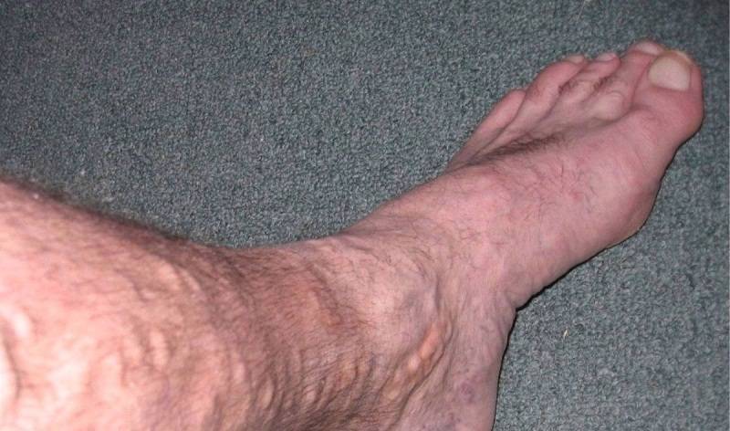 Nguyên nhân, triệu chứng và cách phòng ngừa bệnh suy giãn tính mạch chân