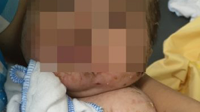 Tắm lá trị bệnh thủy đậu bé trai bị nhiễm độc nặng