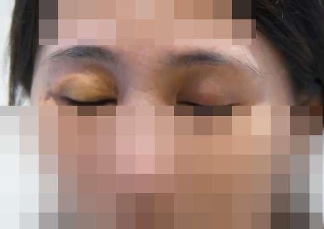 Suýt bị mù vì tiêm silicon làm đẹp mắt