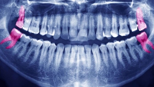 Vì sao nha sĩ khuyên bạn nên nhổ răng khôn trước tuổi 25?