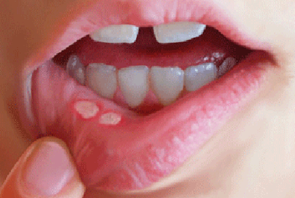'7 phương pháp đơn giản chữa nhiệt miệng, giảm ngay đau đớn và khó chịu