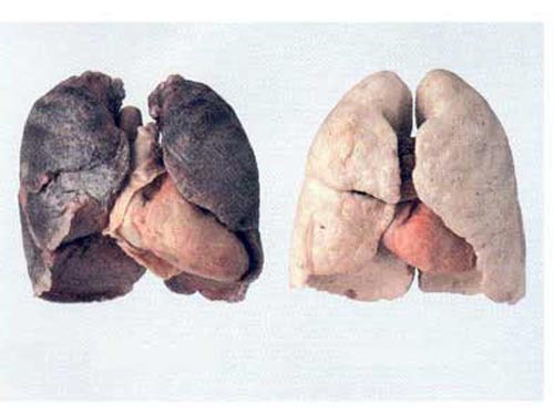 Dấu hiệu “tố” bệnh ung thư phổi