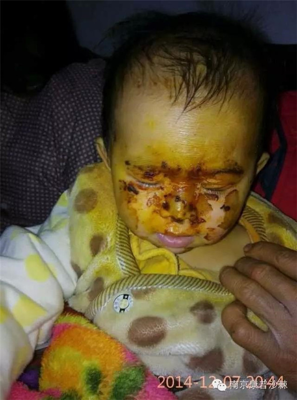 Loại quả kỳ diệu khiến em bé bỏng nặng không còn vết sẹo nào trên mặt