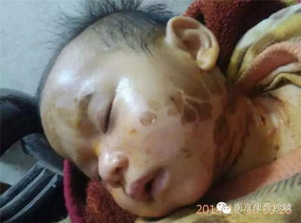 Loại quả kỳ diệu khiến em bé bỏng nặng không còn vết sẹo nào trên mặt