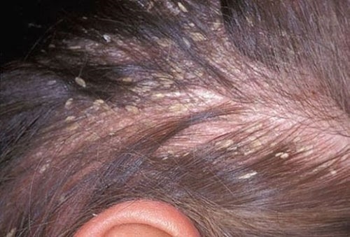 Mắc bệnh da đầu vì…mũ bảo hiểm