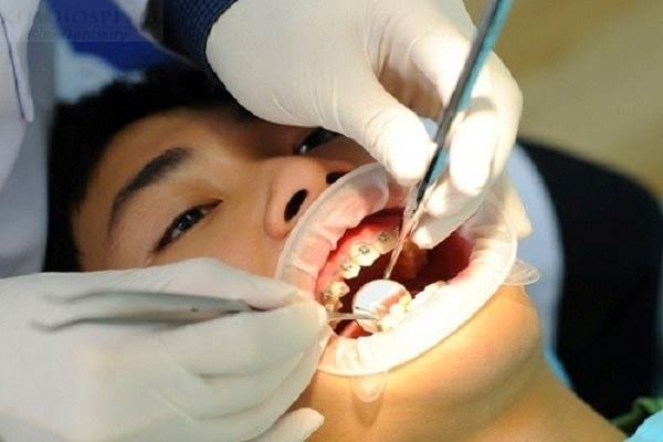 Niềng răng không đúng cách có thể bị 'bay' cả hàm