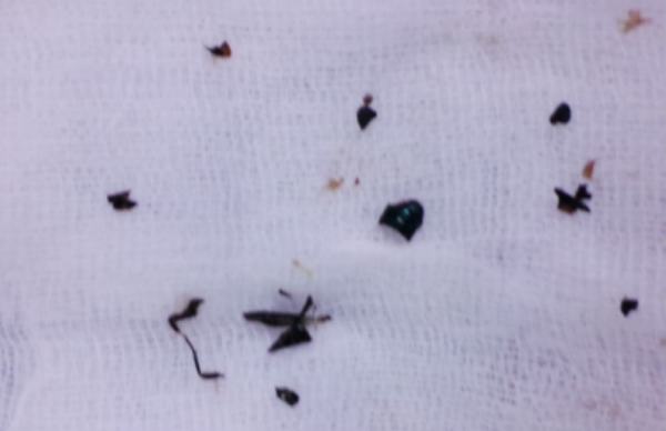 Mẹ giơ tay chộp côn trùng bay trước mặt khiến con 8 tháng tuổi suýt tử vong