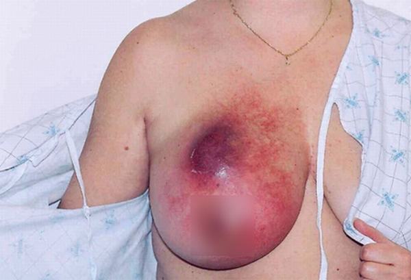 Cô gái 19 tuổi bị ung thư vú bởi thói quen ai cũng làm hằng ngày này