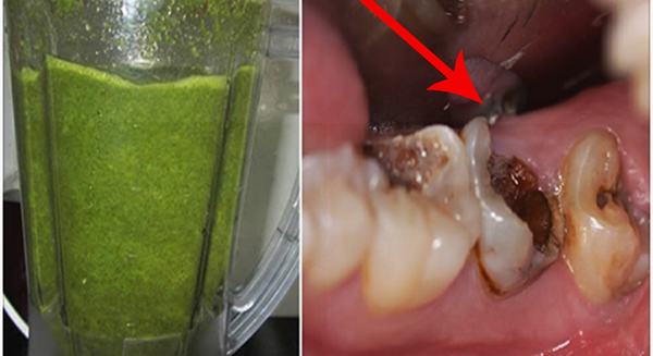 Loại lá đâu cũng có này chữa sâu răng vĩnh viễn hiệu quả hơn dùng thuốc