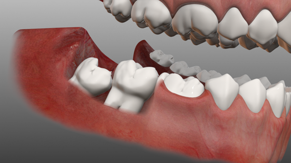 Nhổ răng khôn: Cảnh giác với những biến chứng có thể gây tử vong