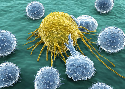 Truyền hóa chất càng 'thúc' tế bào ung thư vú mạnh gấp bội