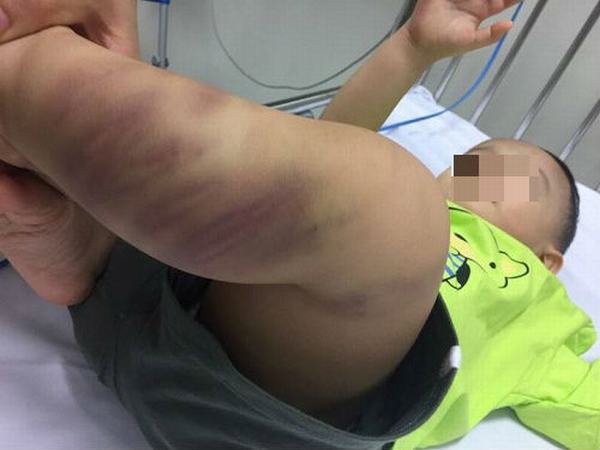 Bé trai 1 tuổi bị bạo hành dã man ở Hà Nội đã rơi vào tình trạng hôn mê sâu
